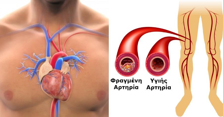 Φραγμένες αρτηρίες: 4 Σιωπηλά σημάδια ότι έχετε πρόβλημα απόφραξης στις αρτηρίες σας